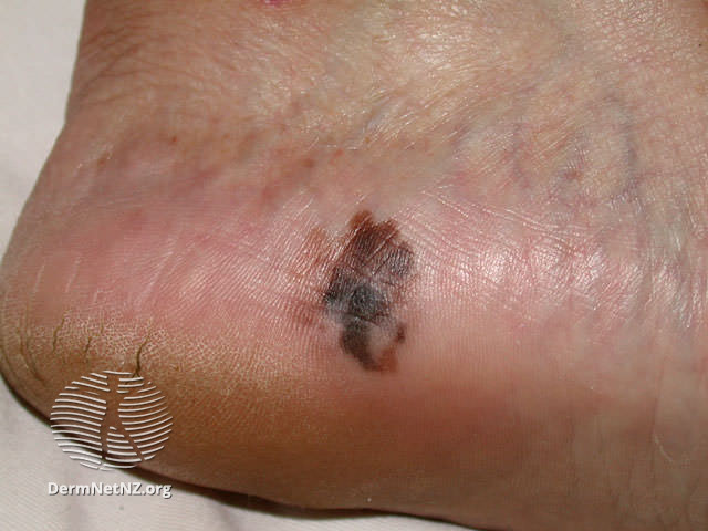 Melanoma-2-1